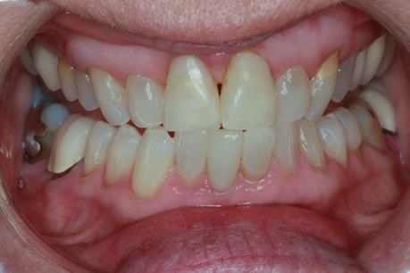 After Single Lower Veneer, to Straighten