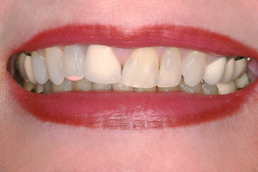Before Six Upper Veneers, to Lenghten & Even Teeth
