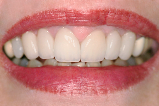 After Six Upper Veneers, to Lenghten & Even Teeth