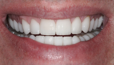 After detail, Full Mouth Rehabilitation for Acid Erosion