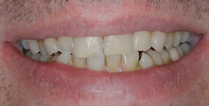 Before detail, Full Mouth Rehabilitation for Acid Erosion