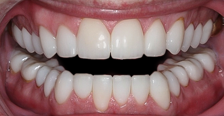 After Full Mouth Rehabilitation for Acid Erosion
