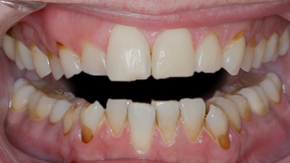 Before Full Mouth Rehabilitation for Acid Erosion