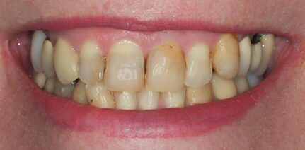 Before Eighteen Veneers