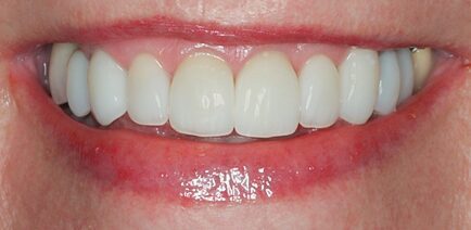 After Eighteen Veneers