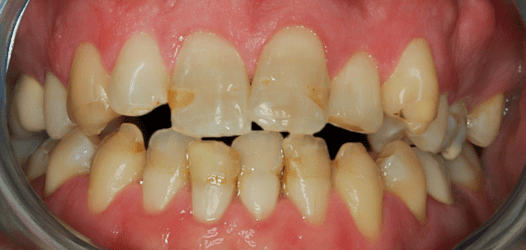 Before Smile Makeover for Crooked Teeth, Full Arch Transformation