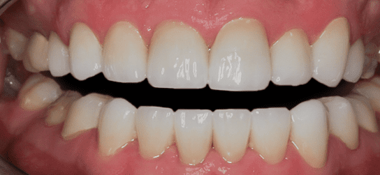 After Smile Makeover for Crooked Teeth, Full Arch Transformation