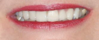 After detail, Eight Upper Veneers Six Lower Veneers, for Crooked Teeth, Pointed Cuspids & Lower Crowding