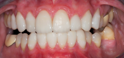After Eight Upper Veneers Six Lower Veneers, for Crooked Teeth, Pointed Cuspids & Lower Crowding