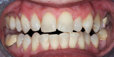 Before Eight Upper Veneers Six Lower Veneers, for Crooked Teeth, Pointed Cuspids & Lower Crowding
