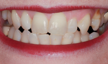 Before detail, Eight Upper Veneers Six Lower Veneers, for Crooked Teeth, Pointed Cuspids & Lower Crowding