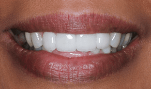 After Smile Makeover for Overcrowding & Lengthening, From Compressed to Confident