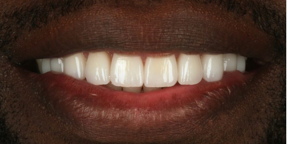 After Jess, reclaimed smile after cancer treatment