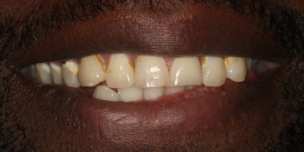 Before Jess, reclaimed smile after cancer treatment