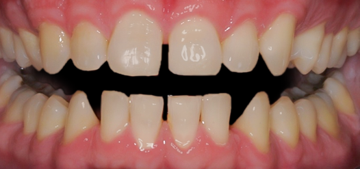 Before detail, Twenty Veneers & Crowns to Close Spaces