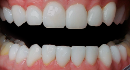 After detail, Twenty Veneers & Crowns to Close Spaces