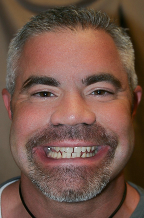 Before Twenty Veneers & Crowns to Close Spaces