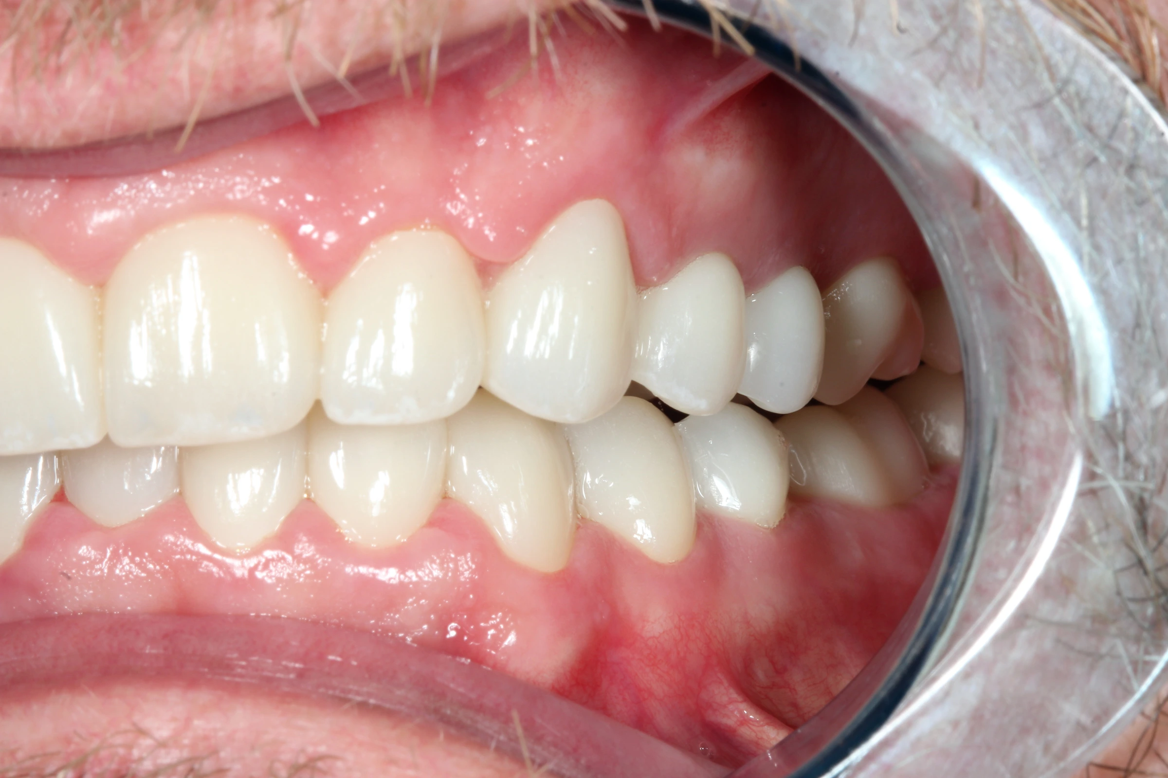Stephen’s after-treatment photograph