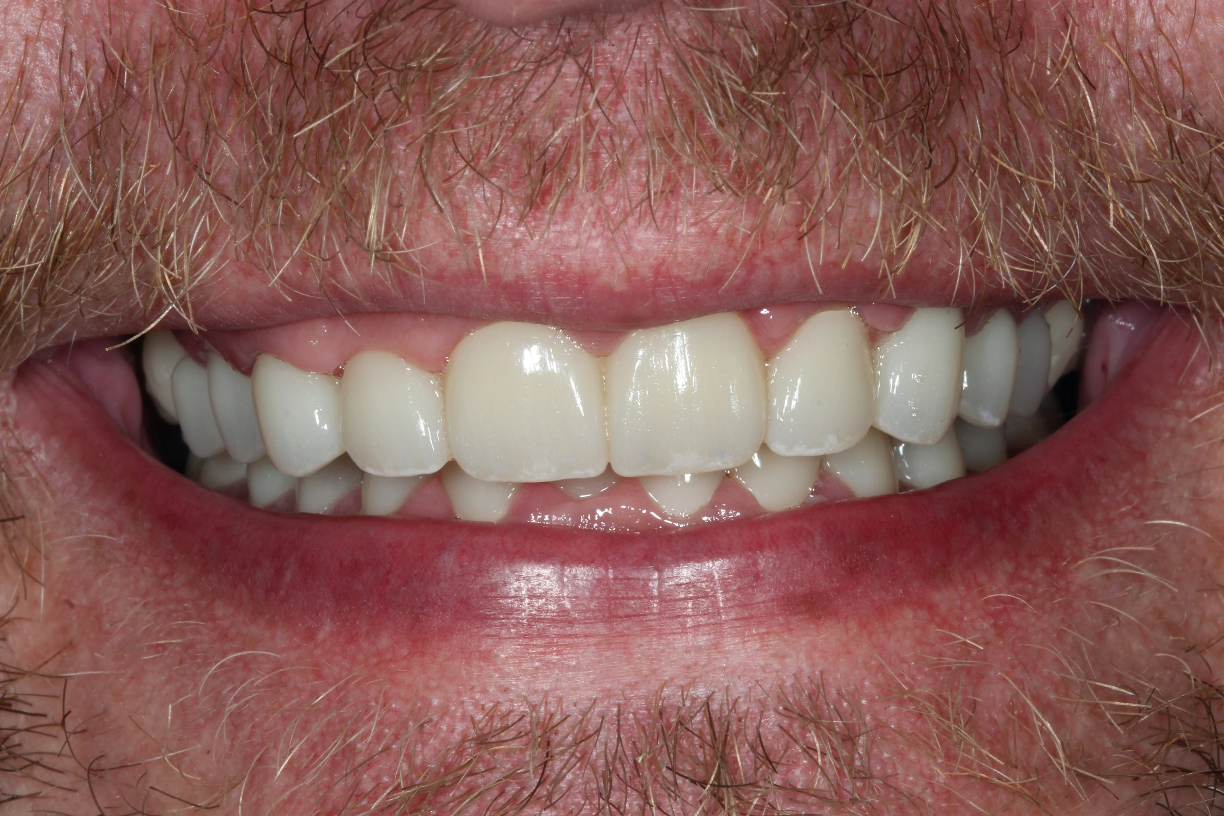 After Stephen’s Smile Rehabilitation