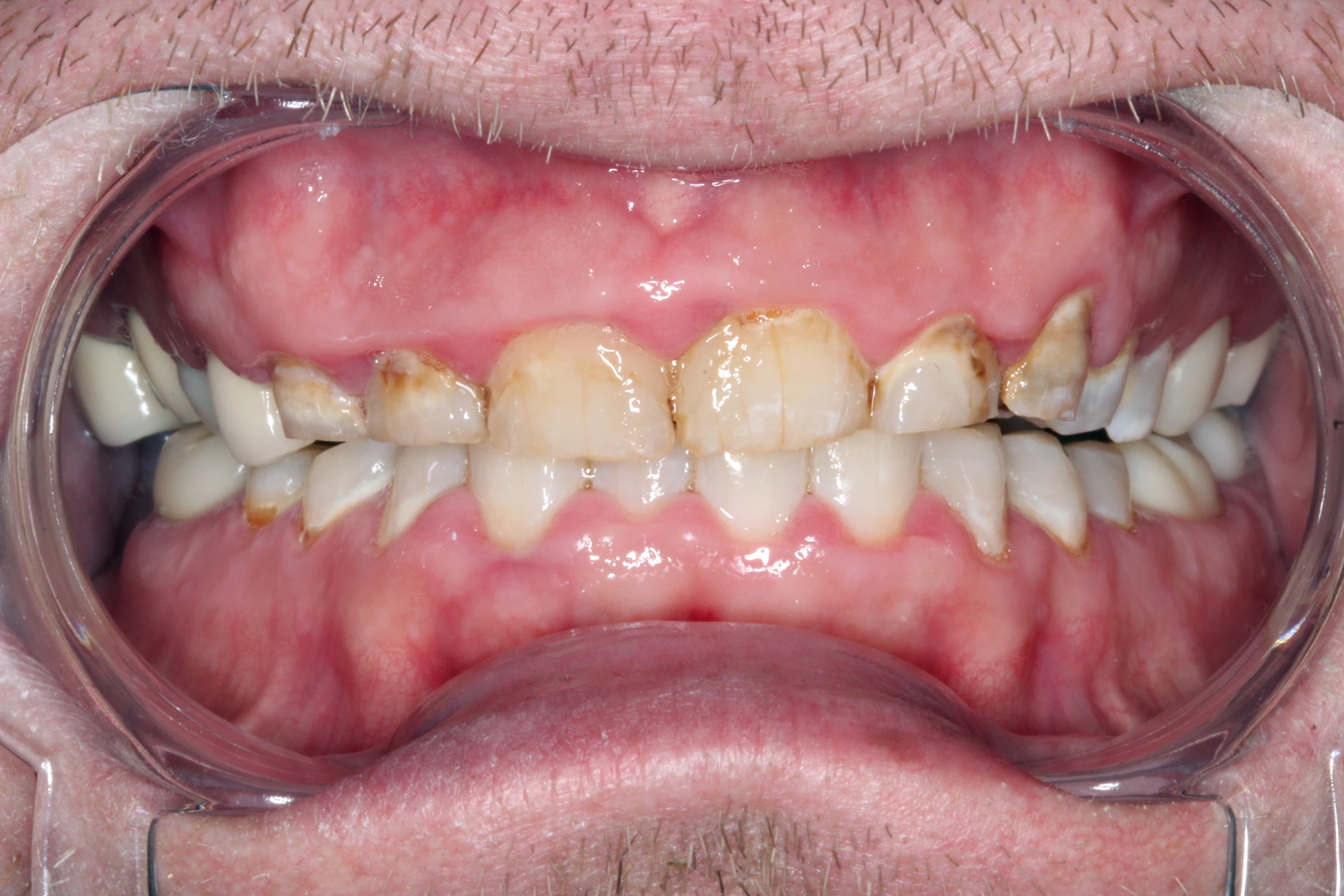 Stephen’s before-treatment photograph