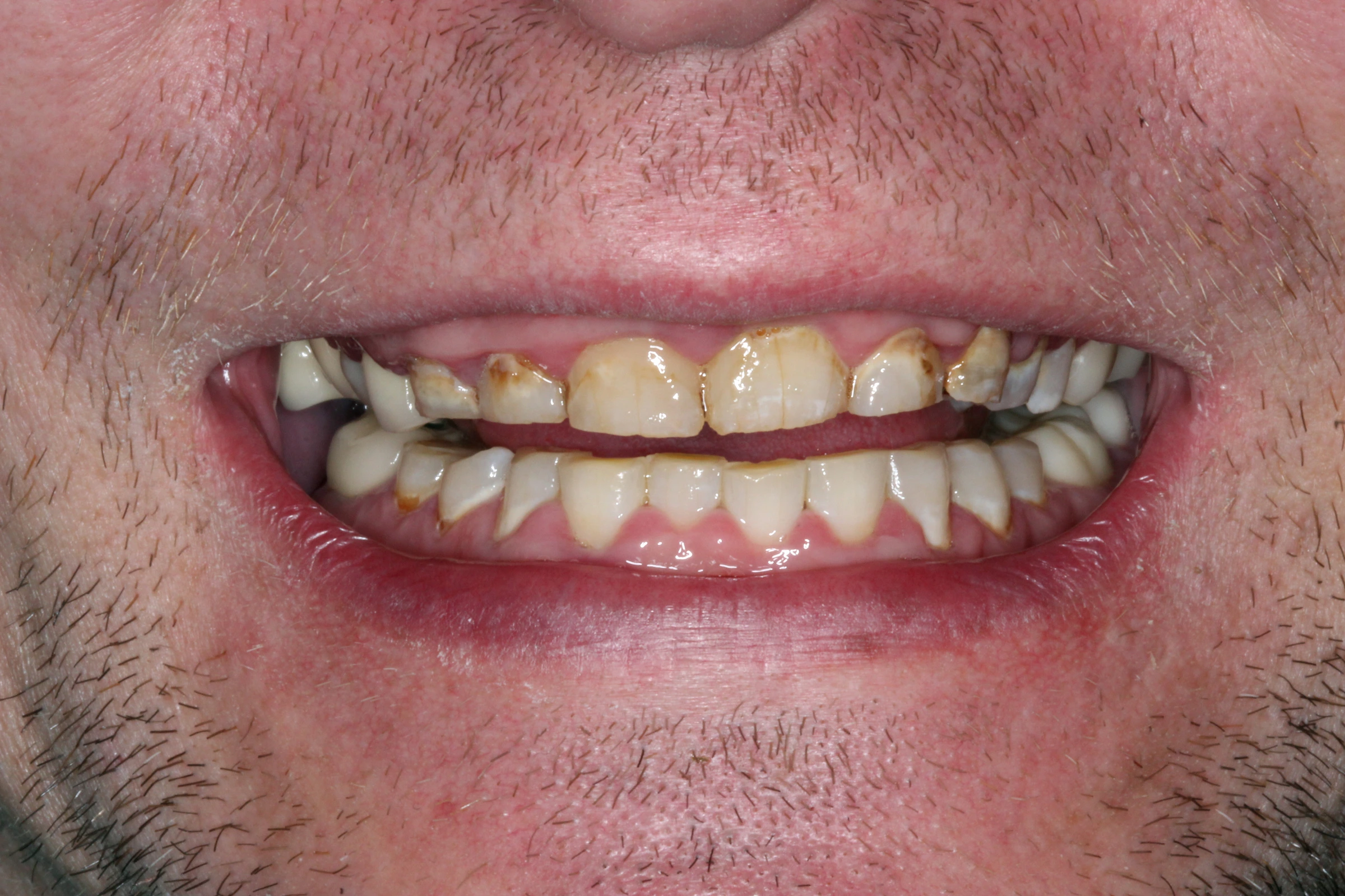Before Stephen’s Smile Rehabilitation