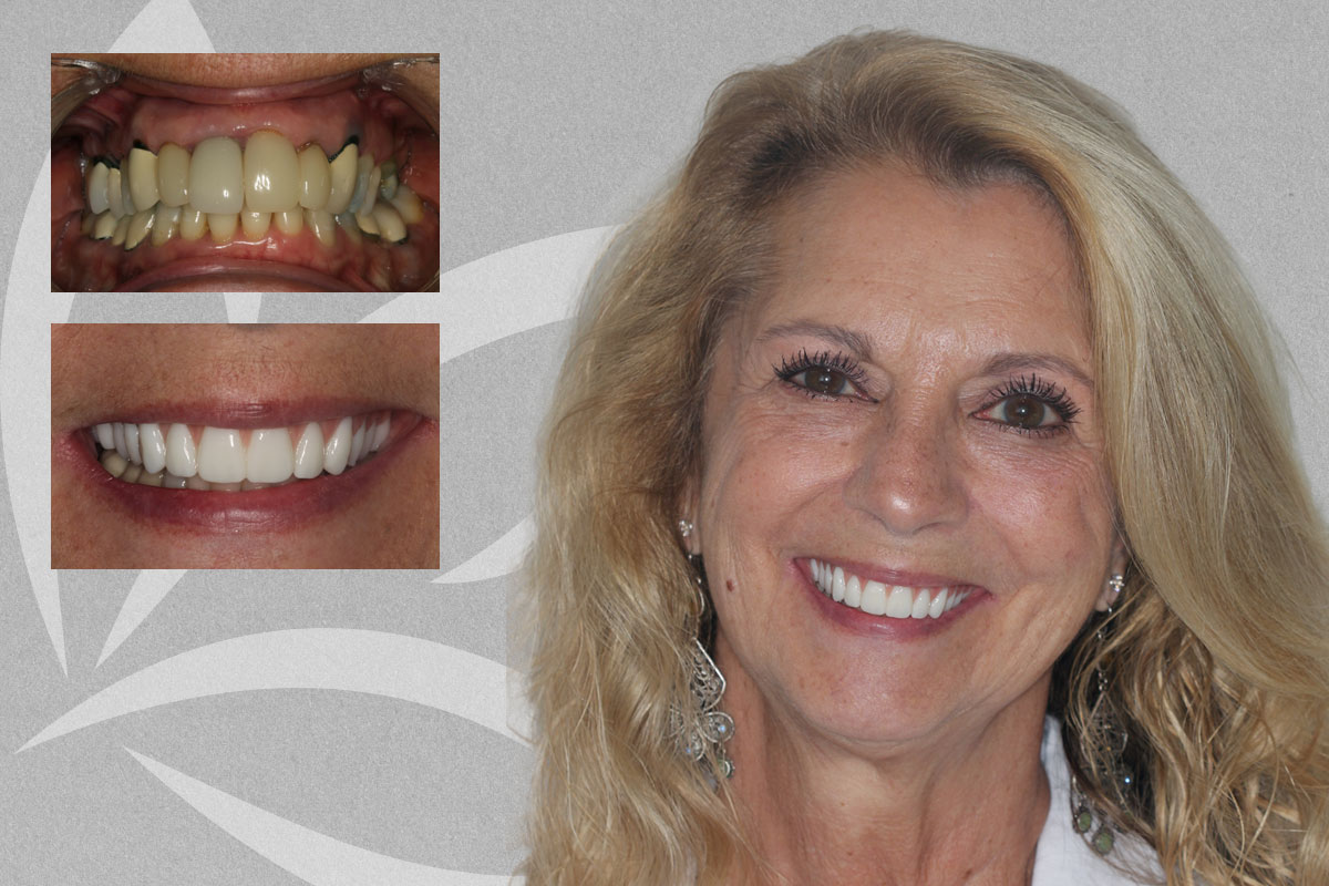 All on 5 Upper, Suzette featured transformation