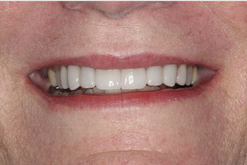 Close-up of Sylvia's smile after eight porcelain veneers