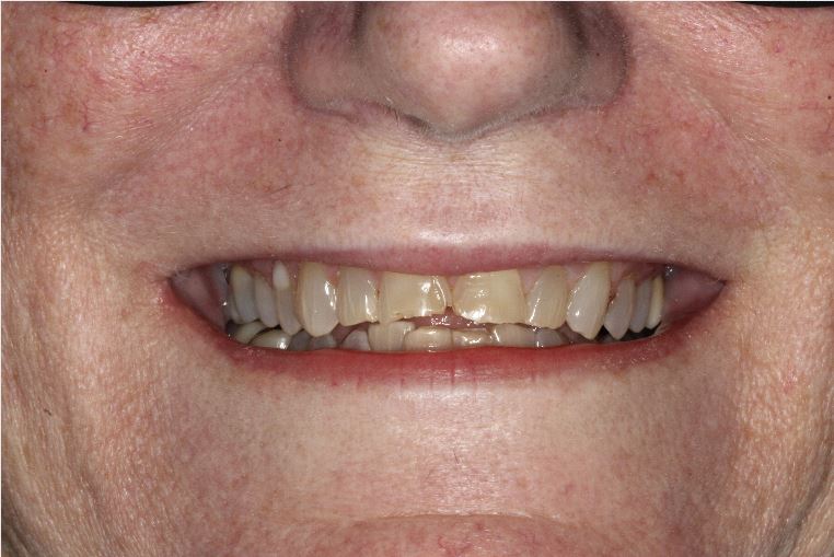Close-up of Sylvia's smile before veneers