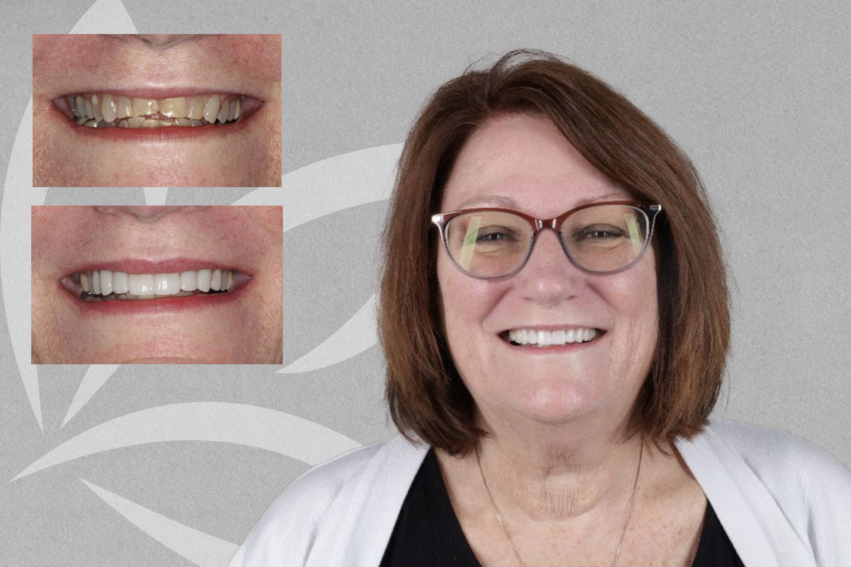 Sylvia smile transformation