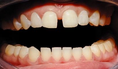 Before Invisalign®, Tamara