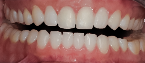 After Invisalign®, Tamara