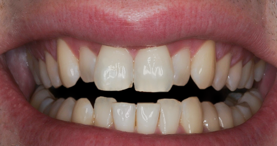 Before detail, Ten Upper Veneers & Crowns Instant Orthodontics, Tom