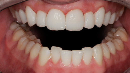 After detail, Ten Upper Veneers & Crowns Instant Orthodontics, Tom