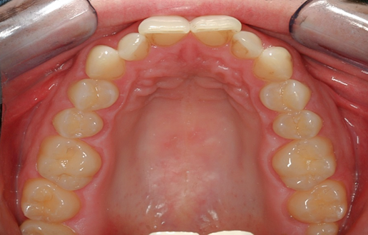 Before Ten Upper Veneers & Crowns Instant Orthodontics, Tom