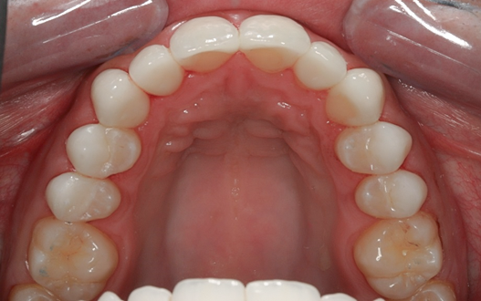 After Ten Upper Veneers & Crowns Instant Orthodontics, Tom