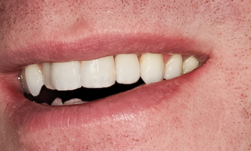 Tooth #10 Implant