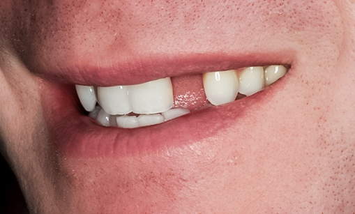Before Tooth #10 Implant