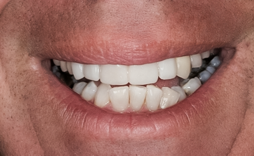 Tooth #10 Implant
