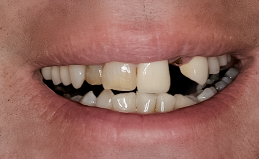 Before Tooth #10 Implant
