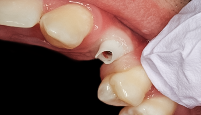 After detail, Tooth #11 Implant with Zirconia Abutment