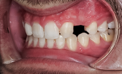 Before Tooth #11 Implant with Zirconia Abutment