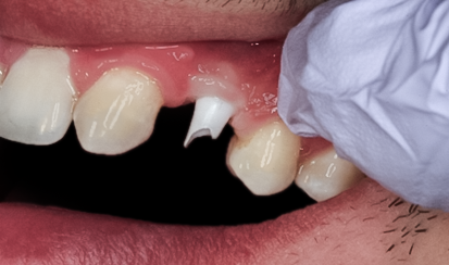 Before detail, Tooth #11 Implant with Zirconia Abutment