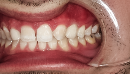 Tooth #11 Implant with Zirconia Abutment