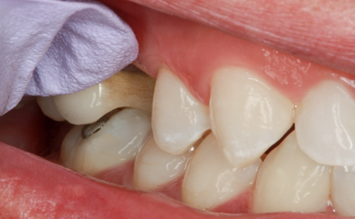 Before Tooth #4 Implant with Zirconia Abutment