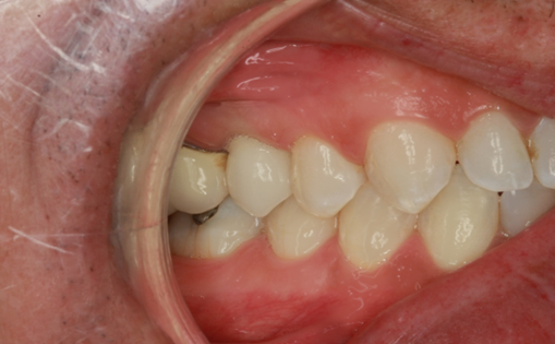 After Tooth #4 Implant with Zirconia Abutment