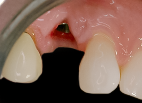 Before detail, Tooth #5 Implant & Tooth #11 Cantilever