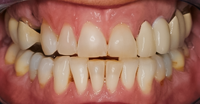 Before Tooth #5 Implant & Tooth #11 Cantilever