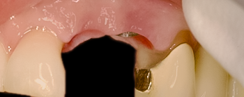 After detail, Tooth #5 Implant & Tooth #11 Cantilever