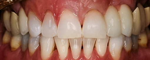 After Tooth #5 Implant & Tooth #11 Cantilever