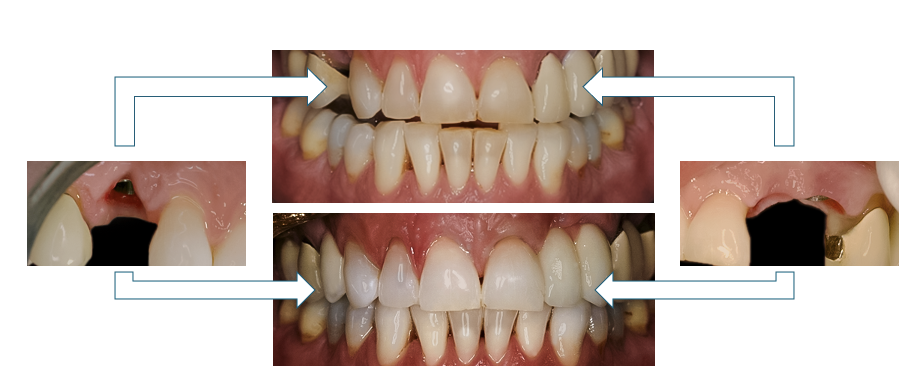 Appliance diagram, Tooth #5 Implant & Tooth #11 Cantilever